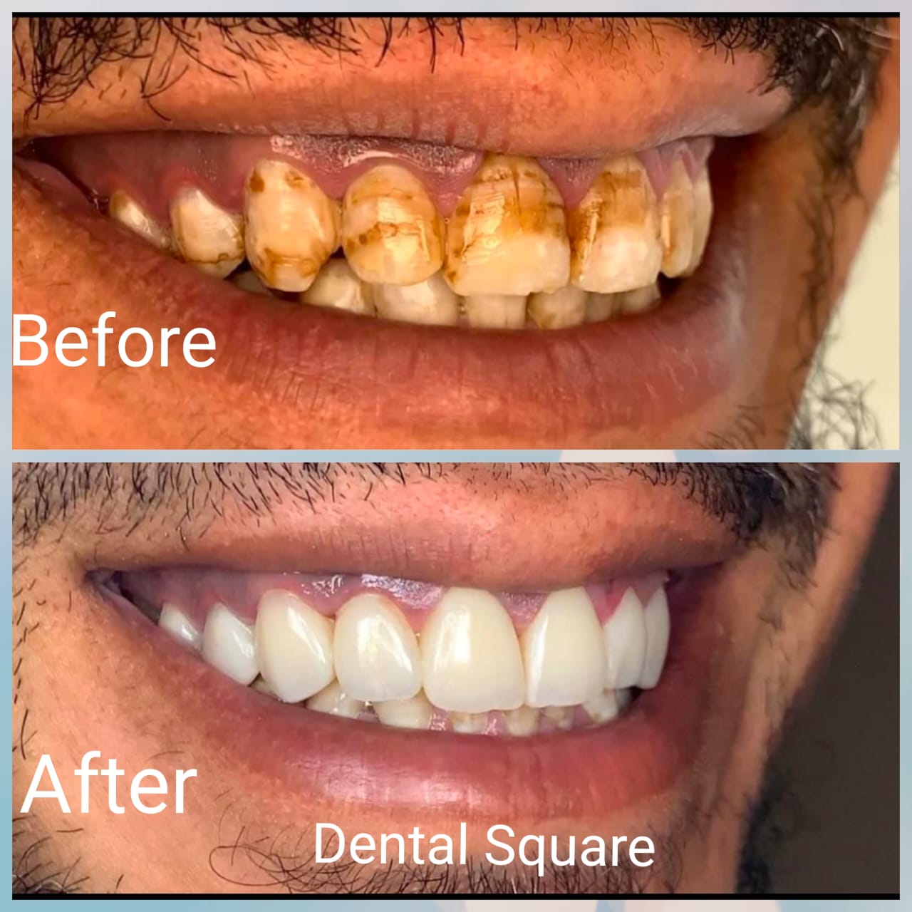 Real patient before and after dental treatment at Dental Square Peshawar, case 1