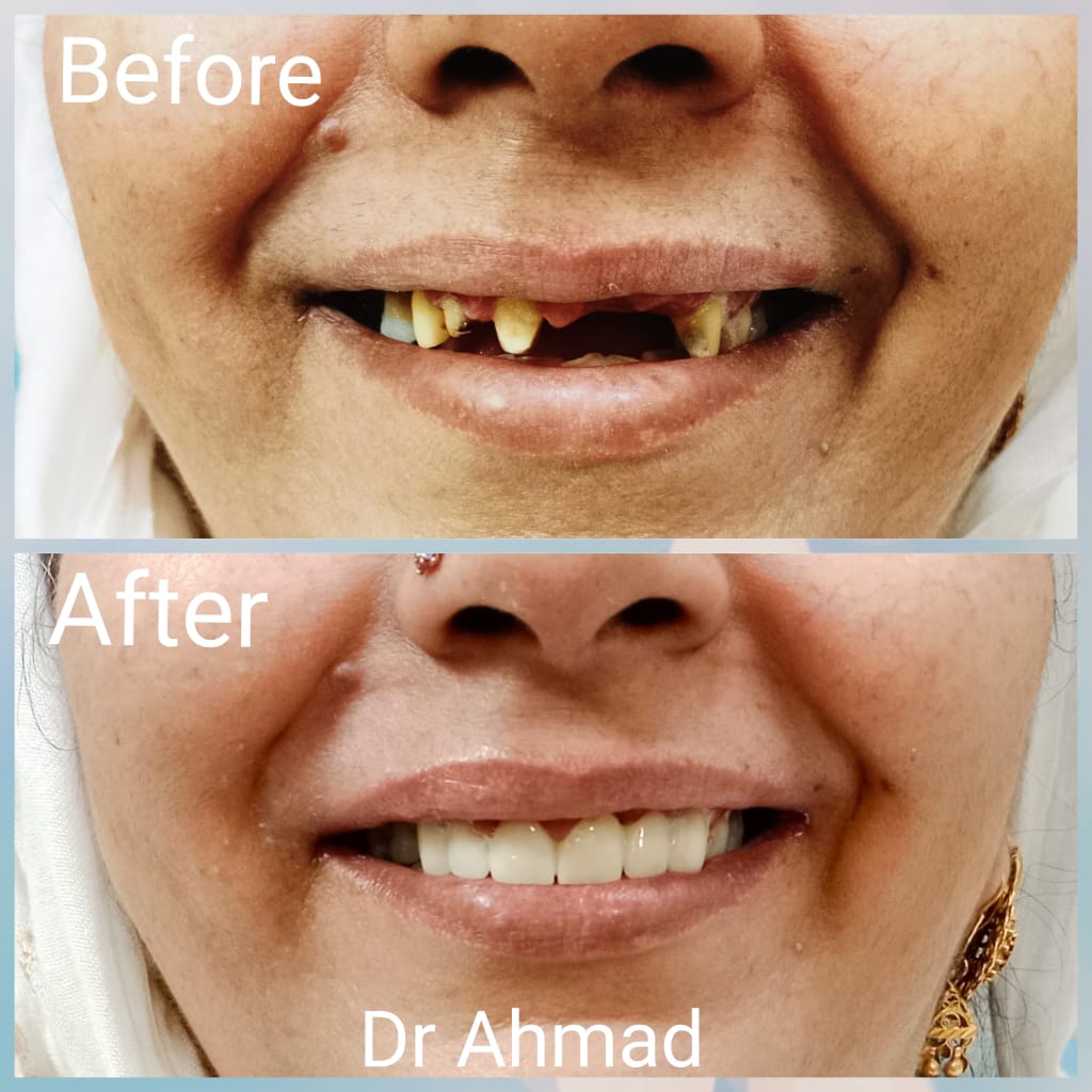 Real patient before and after dental treatment at Dental Square Peshawar, case 10