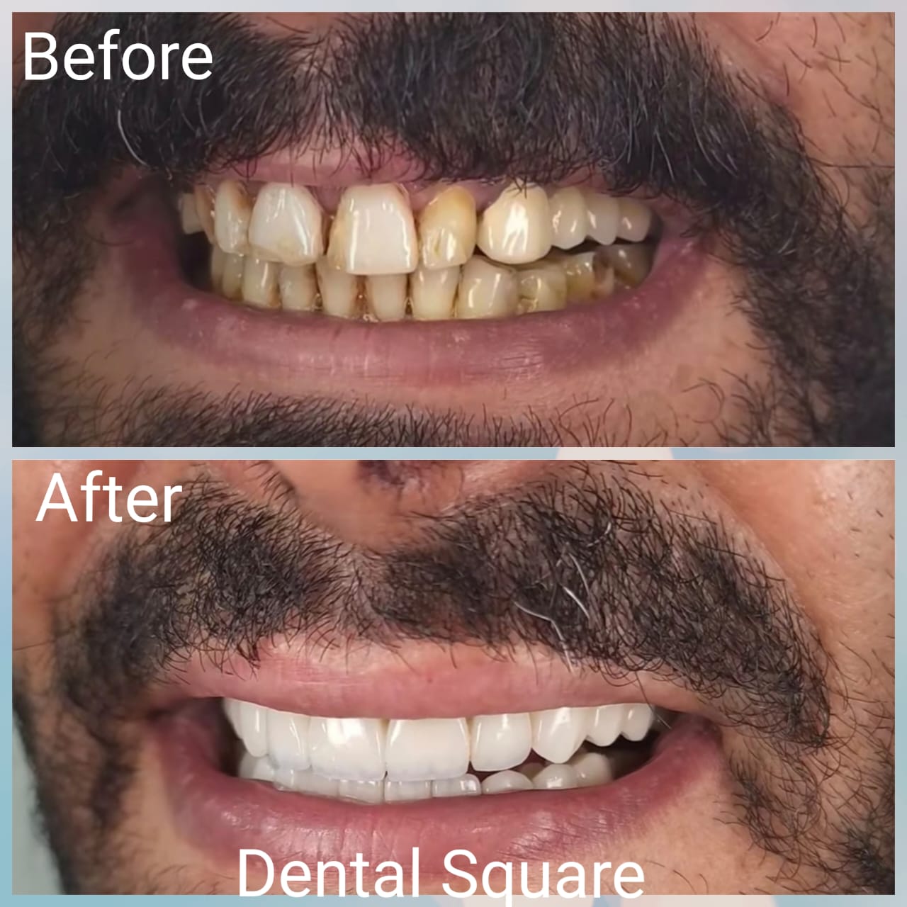 Real patient before and after dental treatment at Dental Square Peshawar, case 3