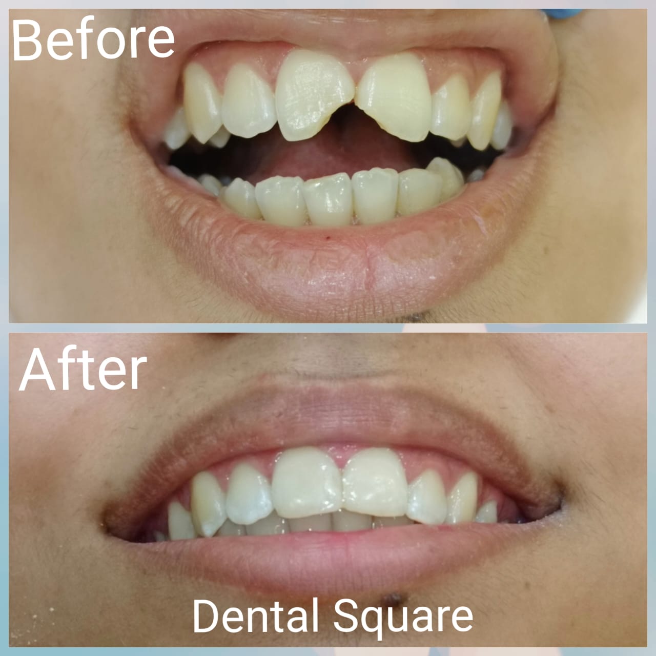 Real patient before and after dental treatment at Dental Square Peshawar, case 12