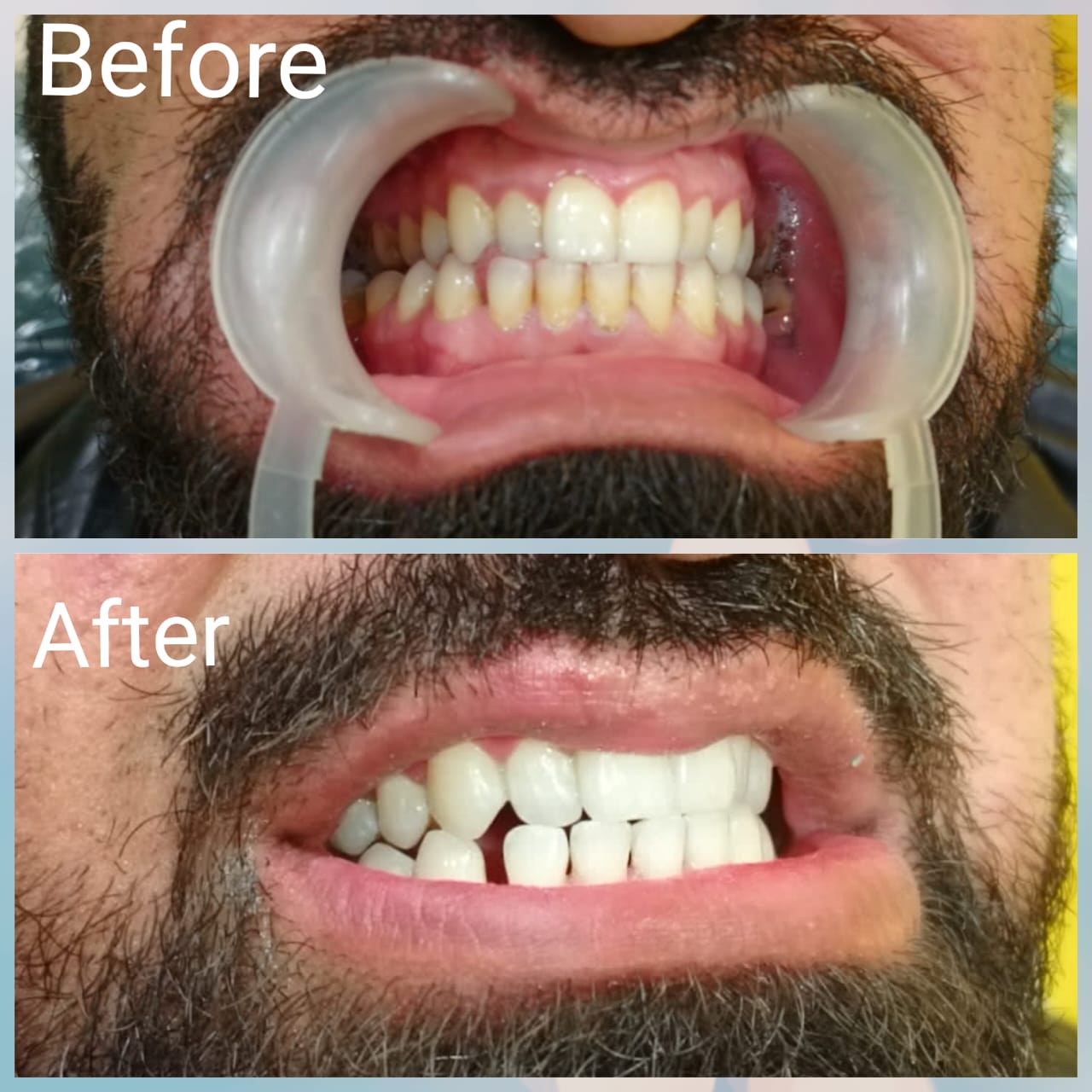 Real patient before and after dental treatment at Dental Square Peshawar, case 13