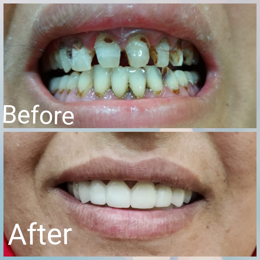 Real patient before and after dental treatment at Dental Square Peshawar, case 14