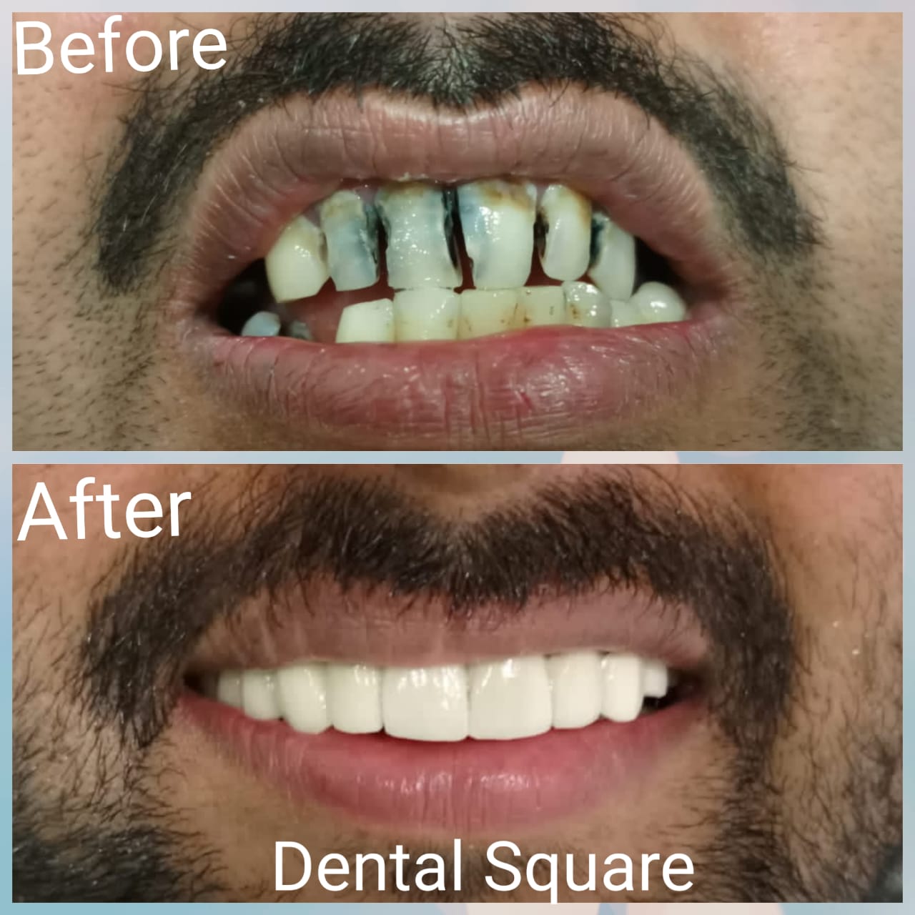 Real patient before and after dental treatment at Dental Square Peshawar, case 15