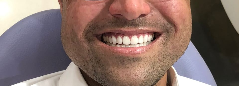 Patient after smile makeover at Dental Square Peshawar