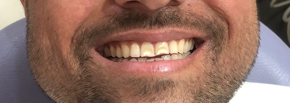 Patient before smile makeover at Dental Square Peshawar