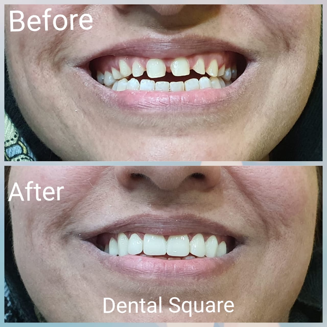 Real patient before and after dental treatment at Dental Square Peshawar, case 2