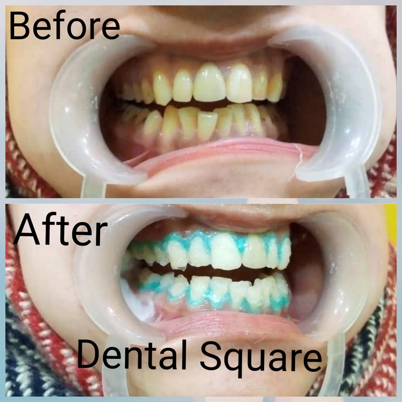 Real patient before and after dental treatment at Dental Square Peshawar, case 3