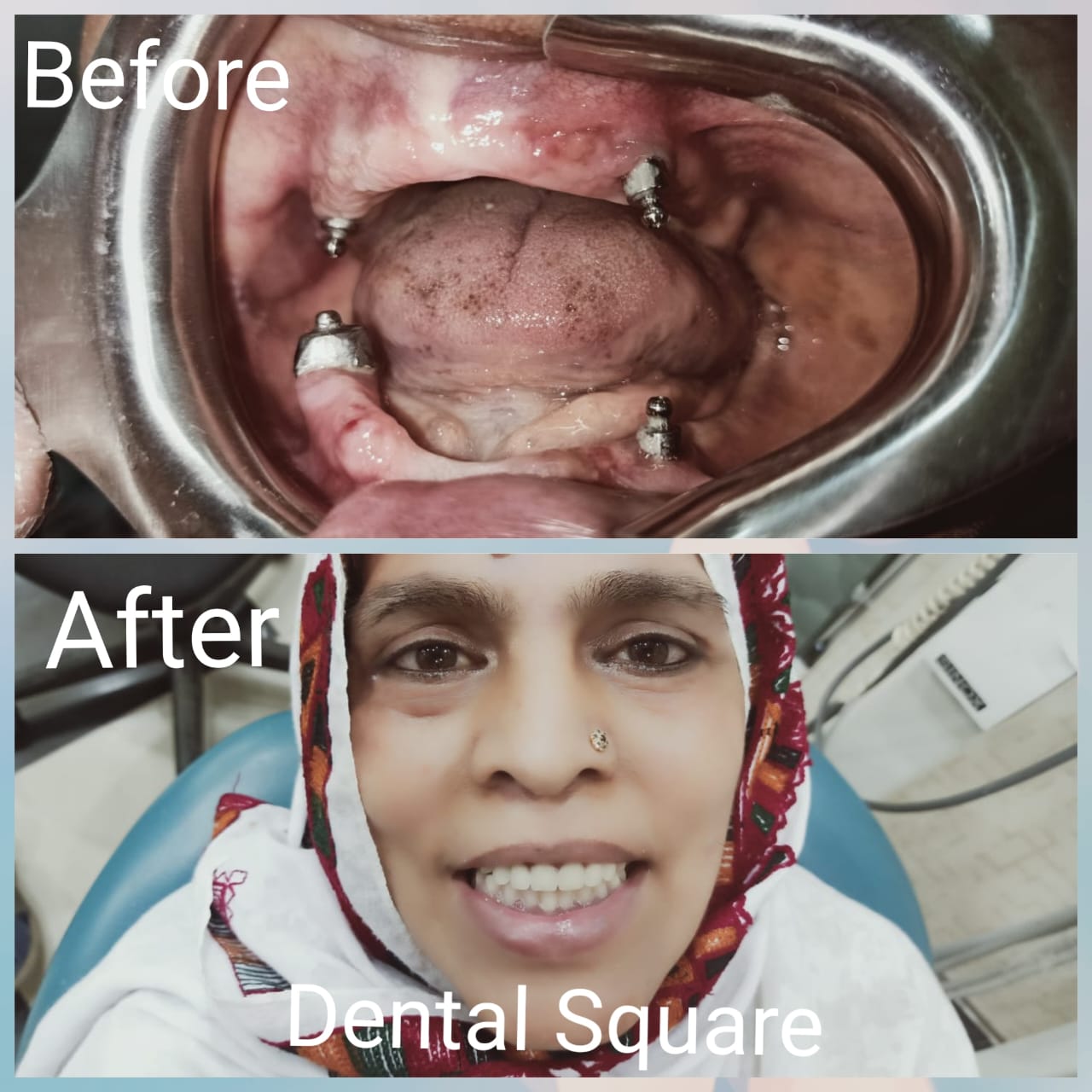 Real patient before and after dental treatment at Dental Square Peshawar, case 4
