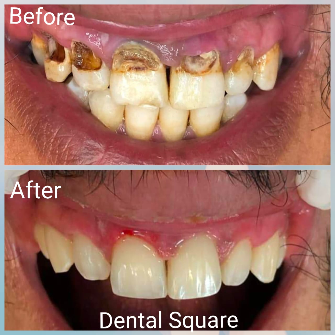 Real patient before and after dental treatment at Dental Square Peshawar, case 5