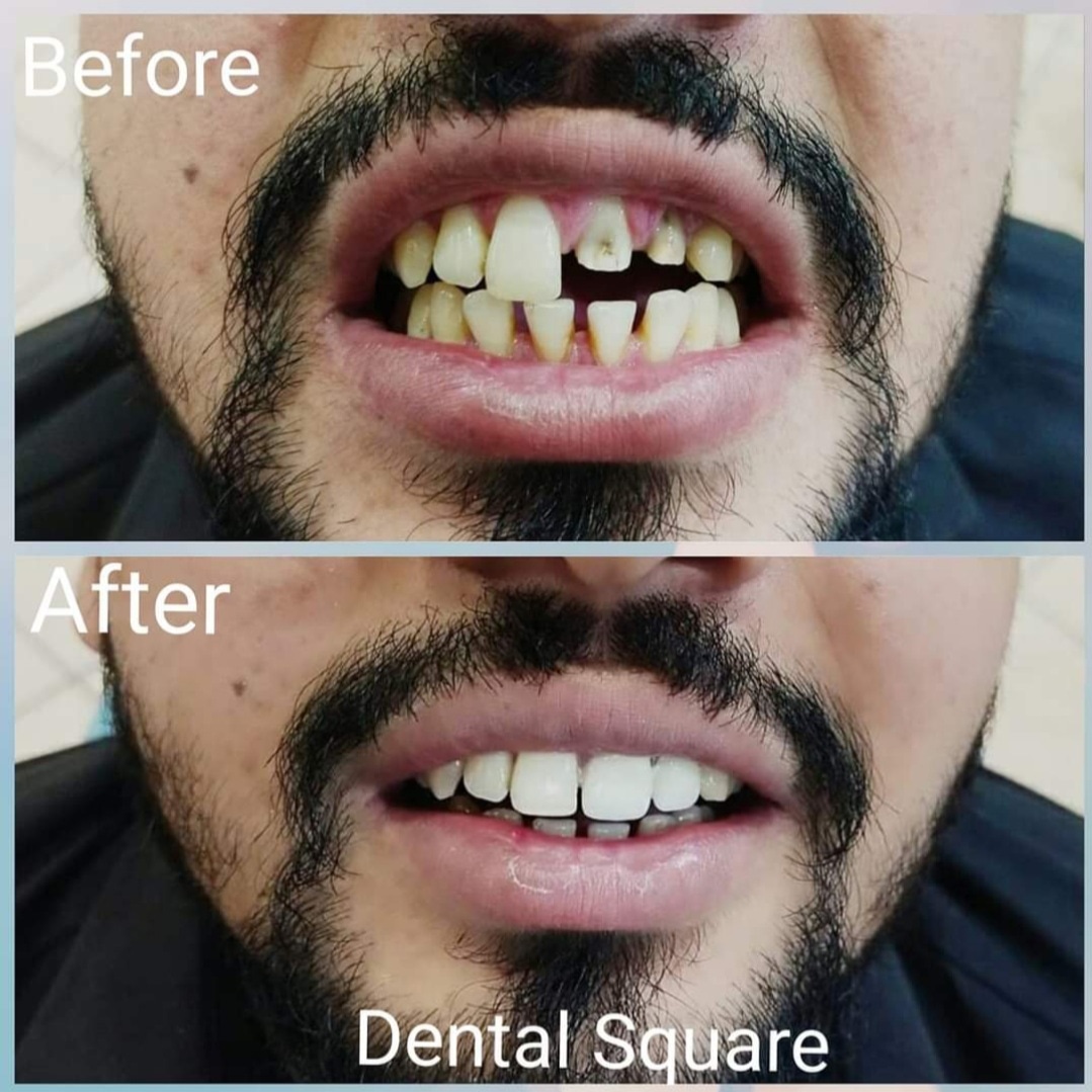 Real patient before and after dental treatment at Dental Square Peshawar, case 2