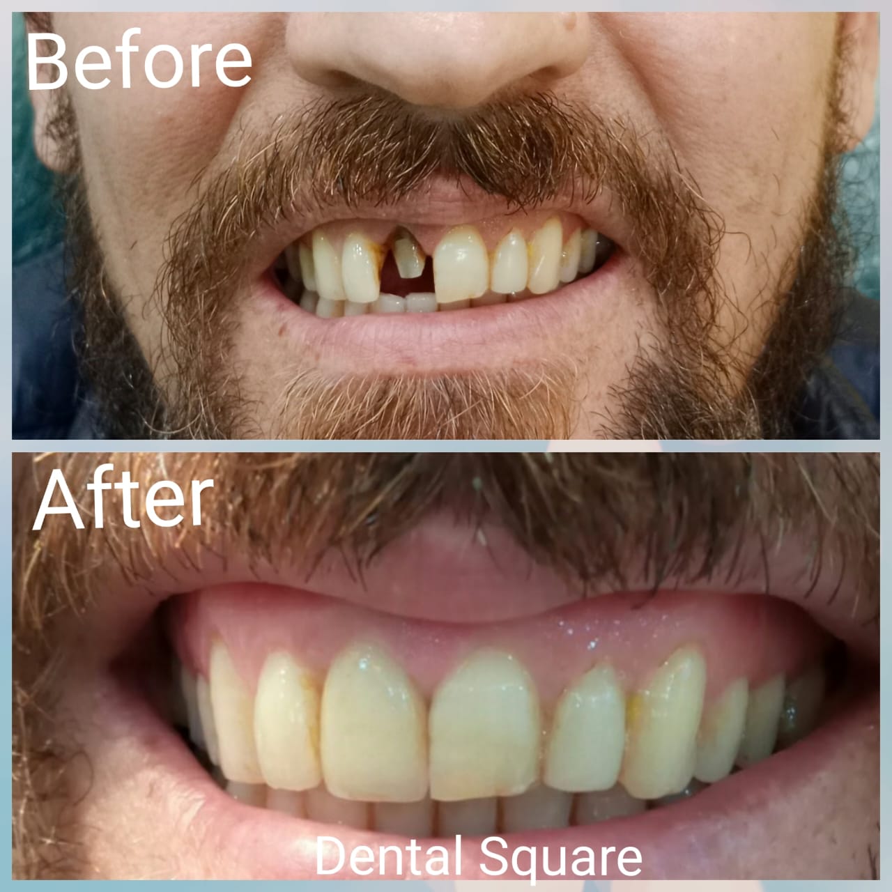 Real patient before and after dental treatment at Dental Square Peshawar, case 7