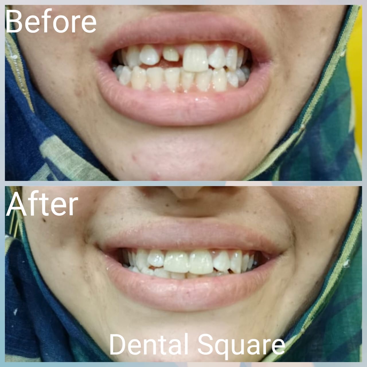 Real patient before and after dental treatment at Dental Square Peshawar, case 8