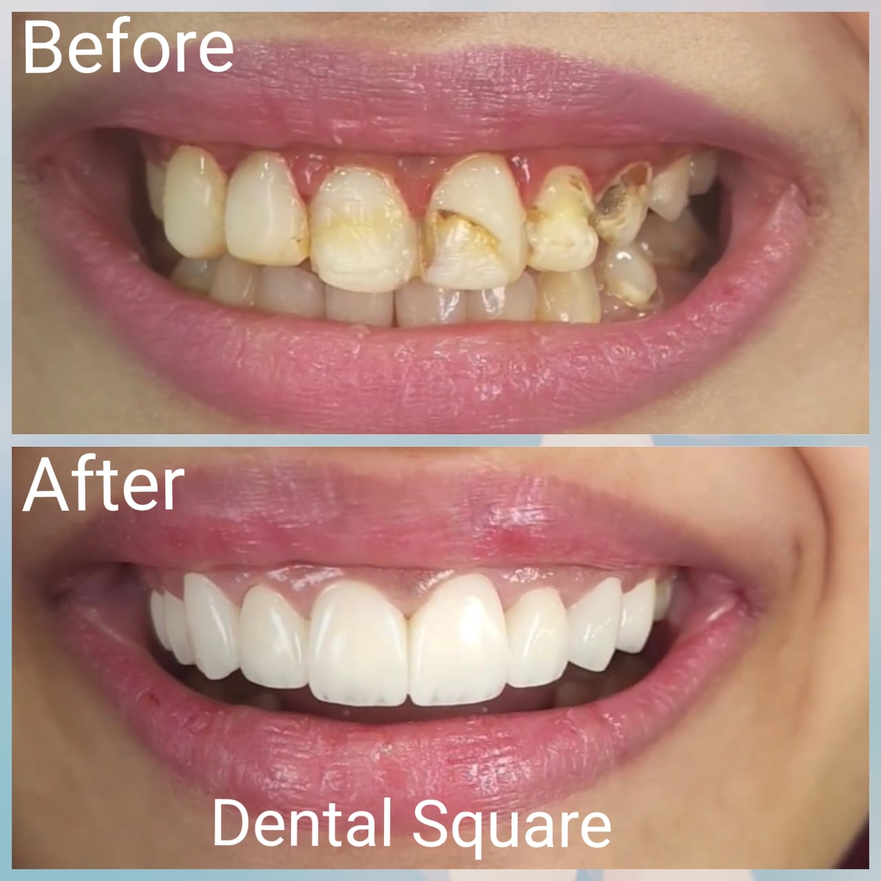 Real patient before and after dental treatment at Dental Square Peshawar, case 9